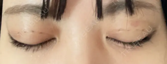 二重埋没 仙台TAクリニック DAY 4 メイン用