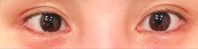 目尻切開 / タレ目形成・グラマラスライン（埋没） LOUIS CLINIC 二子玉川院【ルイクリニック】 DAY 6 メイン用