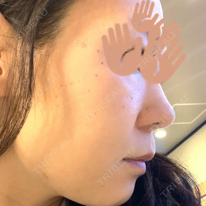 エレクトロポレーション / 毛穴洗浄（ハイドラフェイシャルなど） / ピーリング（ハリ・ツヤ） MYCLINIC 西新宿 AFTER メイン用