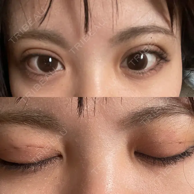 二重埋没 仙台TAクリニック DAY 5 メイン用