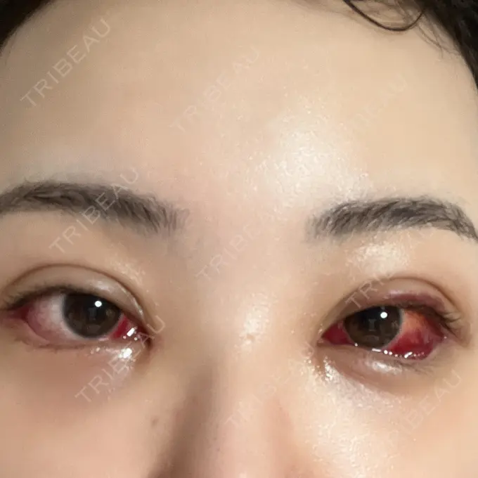 二重埋没 / 目頭切開 / クマ治療 / 目尻切開 / タレ目形成・グラマラスライン（切開） EMMA CLINIC（エマクリニック） DAY 7 メイン用