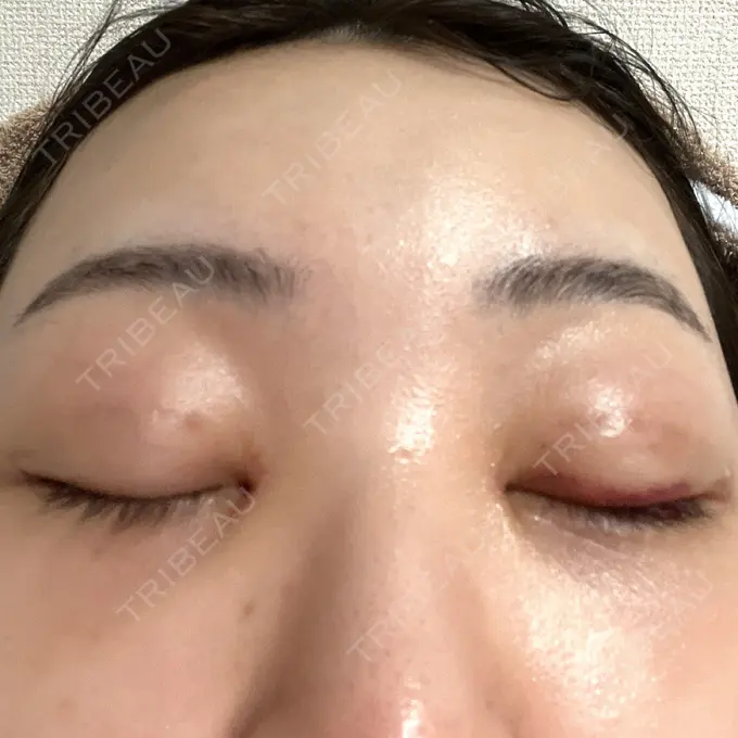 二重埋没 / 目頭切開 / クマ治療 / 目尻切開 / タレ目形成・グラマラスライン（切開） EMMA CLINIC（エマクリニック） DAY 7 メイン用