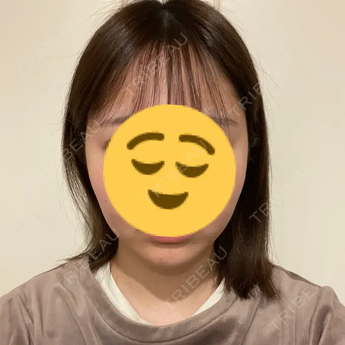 糸リフト / 脂肪吸引（顔） Casa de GRACIA GINZA 【カーサデグラシアギンザ】 DAY 120 メイン用