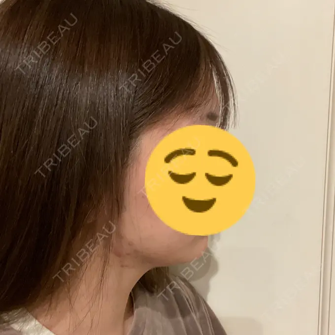 糸リフト / 脂肪吸引（顔） Casa de GRACIA GINZA 【カーサデグラシアギンザ】 DAY 120 メイン用