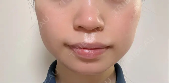 ボトックス（エラ・小顔） TCB東京中央美容外科 立川院 AFTER メイン用