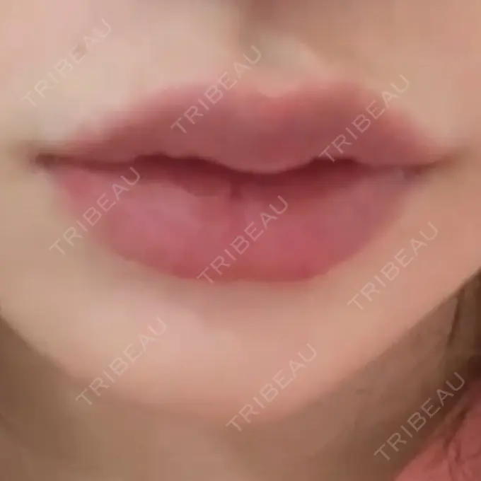 ボトックス（口角） しらゆりメディカルクリニック （旧しらゆりビューティークリニック） AFTER メイン用