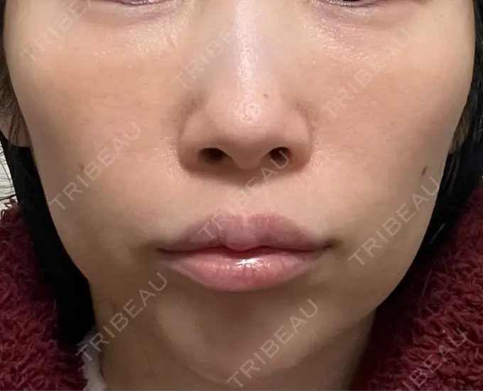 ハイフ（顔） 椿クリニック 心斎橋院 DAY 13 メイン用