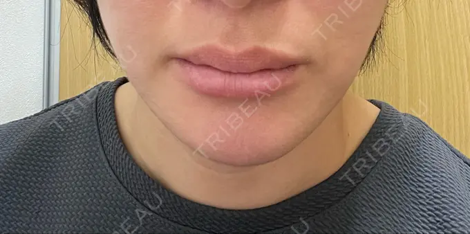 脂肪溶解注射（顔） 表参道ウィズ・クリニック DAY 8 メイン用