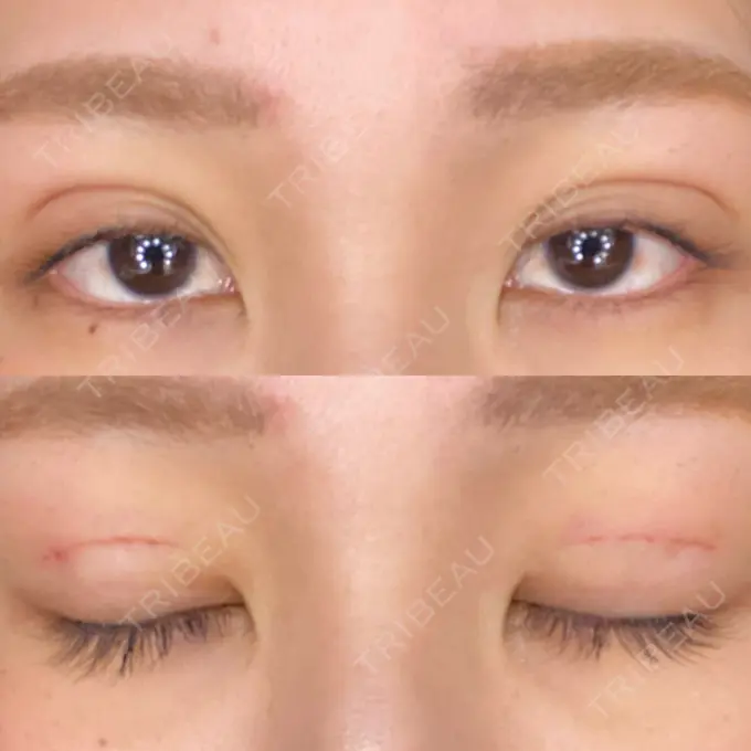 二重埋没 城本クリニック 大阪院 DAY 2 メイン用