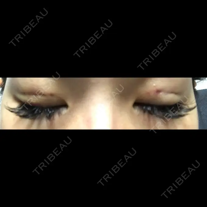 二重埋没 / 上まぶたの脂肪取り TCB東京中央美容外科 仙台駅前院 DAY 1 メイン用