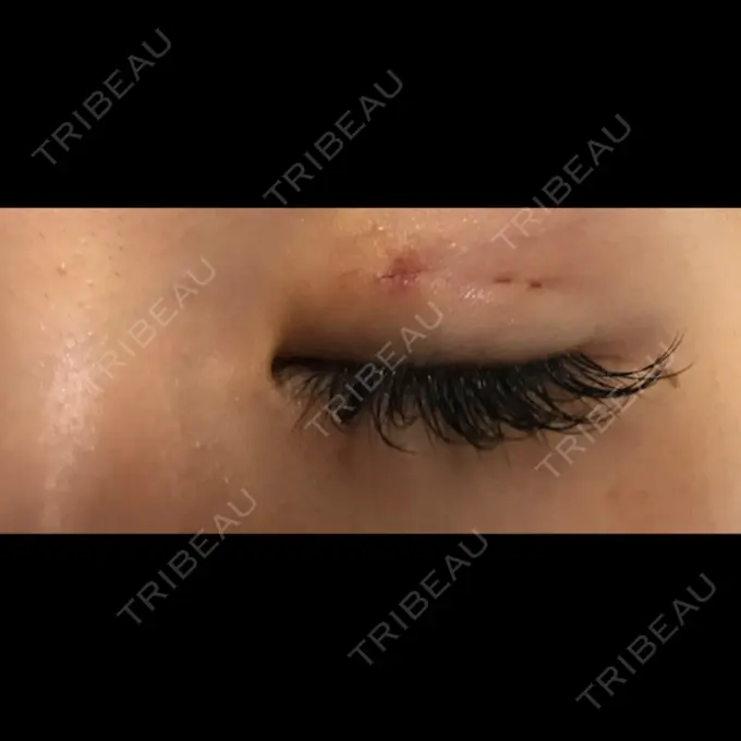 二重埋没 / 上まぶたの脂肪取り TCB東京中央美容外科 仙台駅前院 DAY 3 メイン用