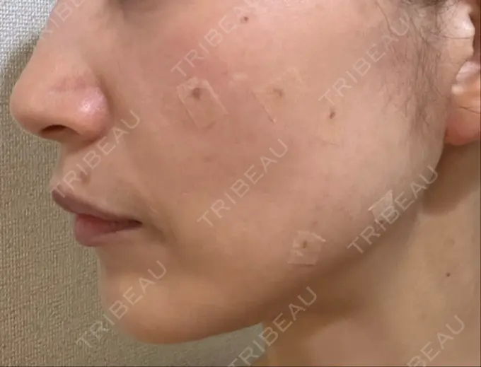 ルビーレーザー S-Laboクリニック 渋谷院 DAY 9 メイン用