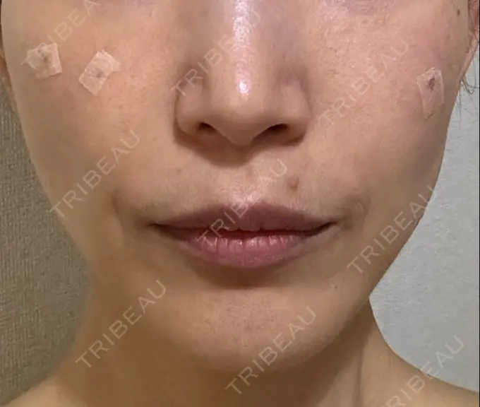 ルビーレーザー S-Laboクリニック 渋谷院 DAY 9 メイン用