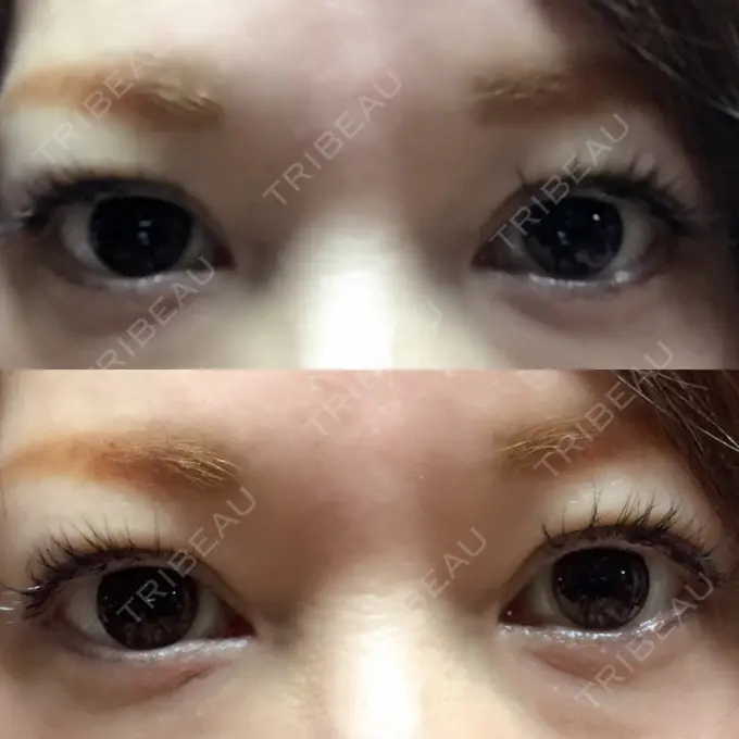 二重埋没 湘南美容クリニック 東京蒲田院 DAY 30 メイン用