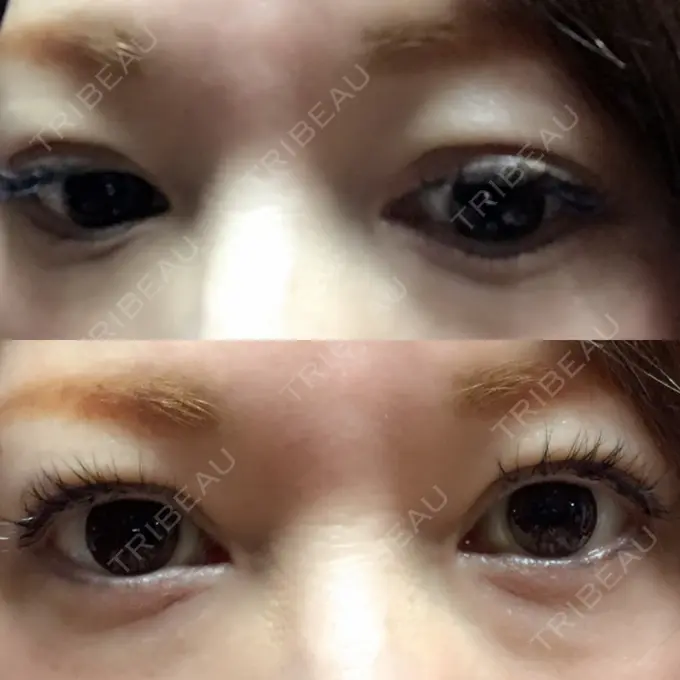 二重埋没 湘南美容クリニック 東京蒲田院 DAY 30 メイン用