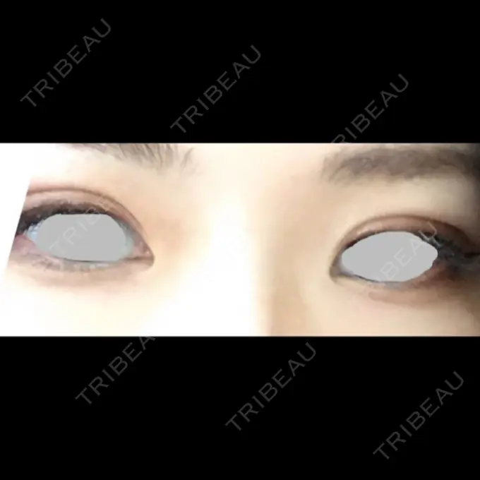 二重埋没 / 上まぶたの脂肪取り TCB東京中央美容外科 仙台駅前院 DAY 10 メイン用