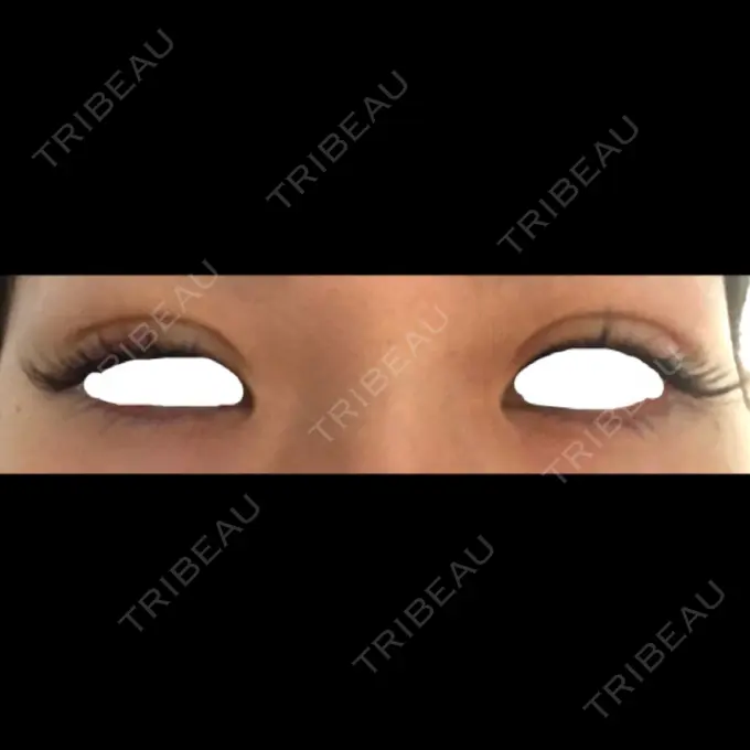 二重埋没 / 上まぶたの脂肪取り TCB東京中央美容外科 仙台駅前院 DAY 5 メイン用