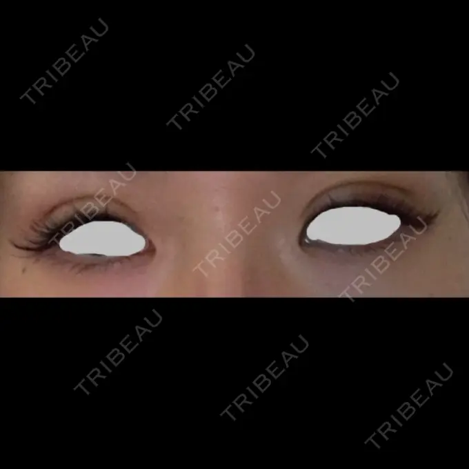 二重埋没 / 上まぶたの脂肪取り TCB東京中央美容外科 仙台駅前院 DAY 3 メイン用