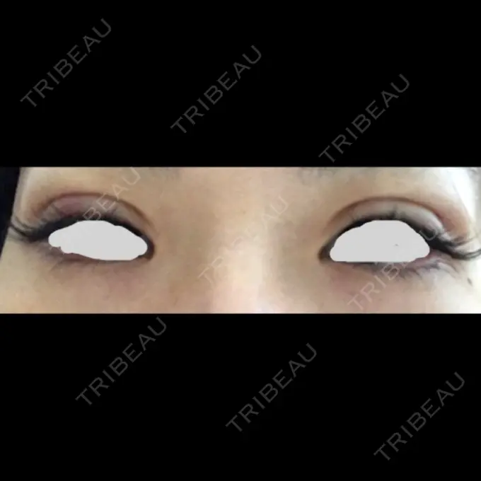 二重埋没 / 上まぶたの脂肪取り TCB東京中央美容外科 仙台駅前院 DAY 1 メイン用