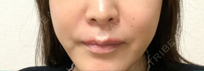 脂肪溶解注射（顔） 東京たかはしクリニック 練馬院 DAY 6 メイン用