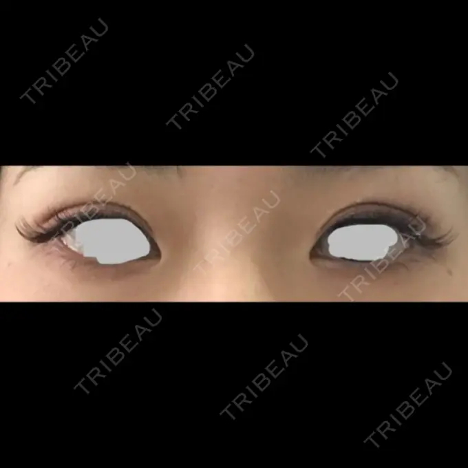 二重埋没 / 上まぶたの脂肪取り TCB東京中央美容外科 仙台駅前院 AFTER メイン用