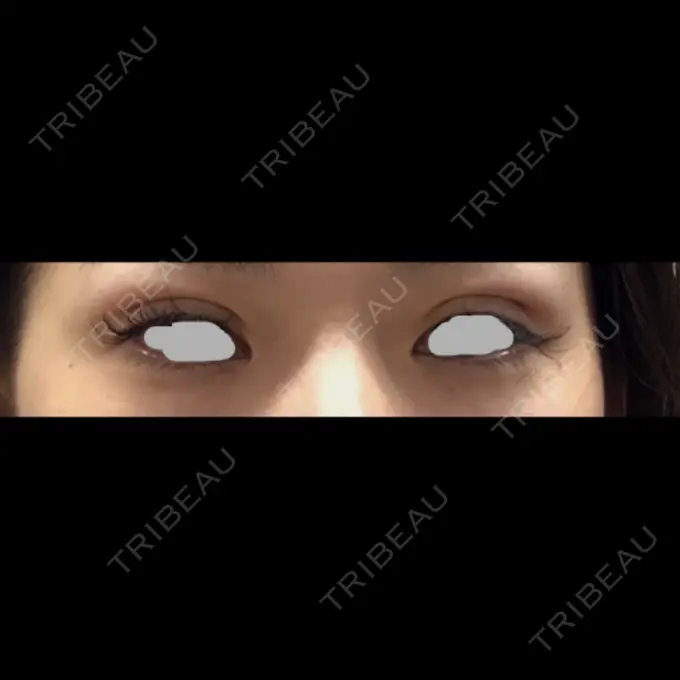 二重埋没 / 上まぶたの脂肪取り TCB東京中央美容外科 仙台駅前院 DAY 0 メイン用