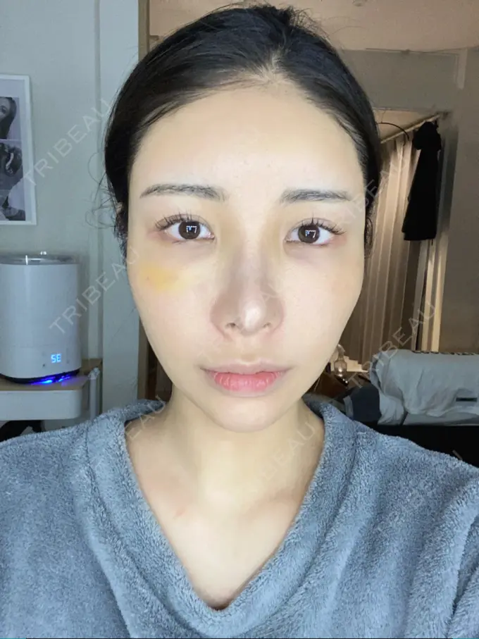 額を丸く / 脂肪注入（額） / 脂肪注入（目の下） ルーチェクリニック 銀座院 DAY 6 メイン用