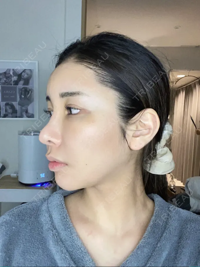 額を丸く / 脂肪注入（額） / 脂肪注入（目の下） ルーチェクリニック 銀座院 DAY 6 メイン用