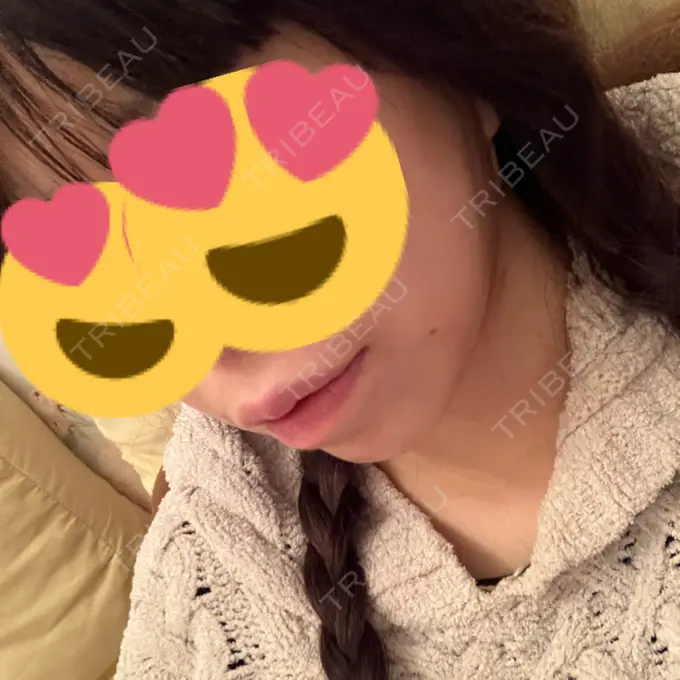 糸リフト / バッカルファット除去 / 脂肪吸引（顔） RIVER CLINIC（リバークリニック） DAY 0 メイン用