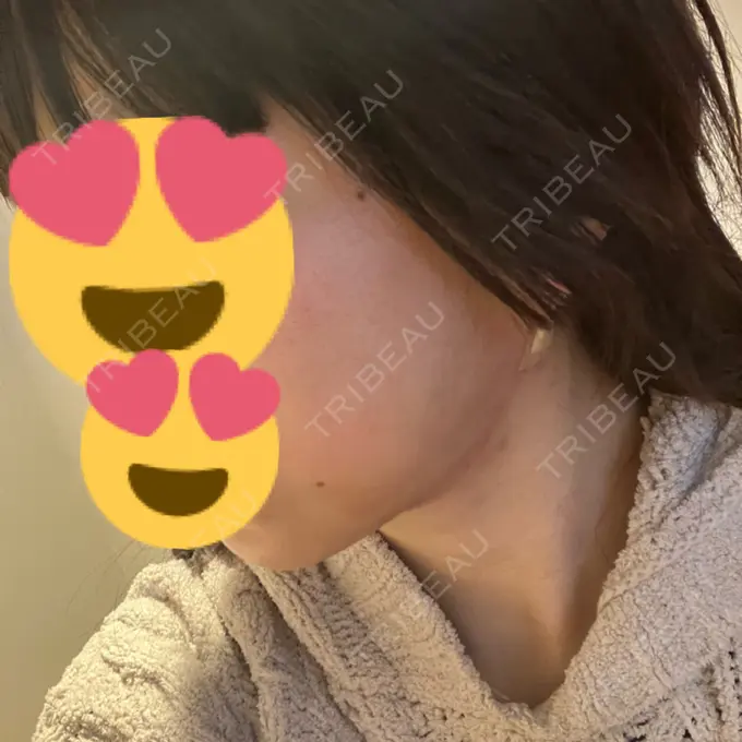 糸リフト / バッカルファット除去 / 脂肪吸引（顔） RIVER CLINIC（リバークリニック） DAY 1 メイン用