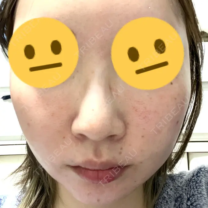 ニードルRF（ポテンツァなど） 東京美容外科 池袋院 AFTER メイン用