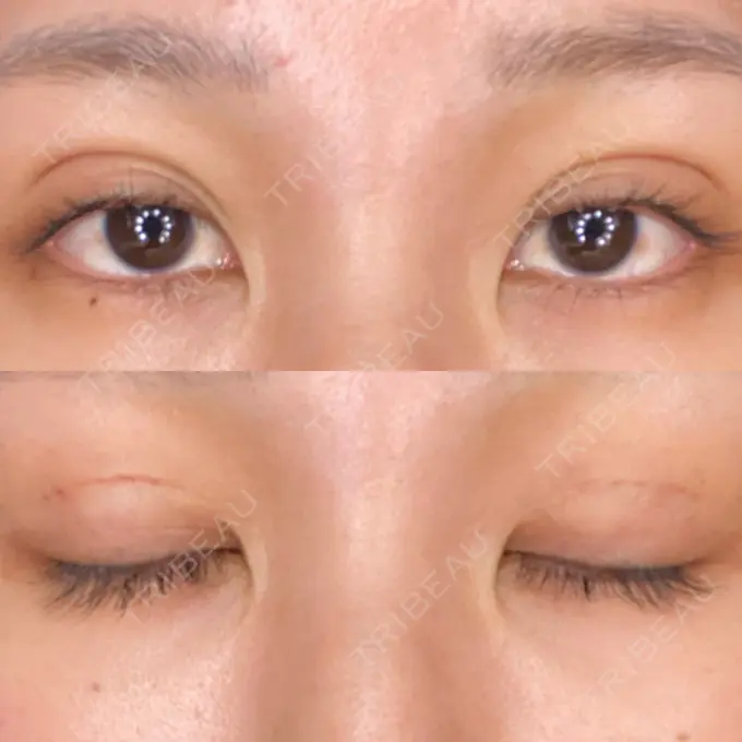 二重埋没 城本クリニック 大阪院 DAY 3 メイン用