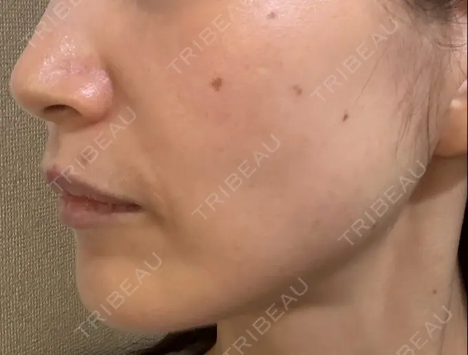 ルビーレーザー S-Laboクリニック 渋谷院 DAY 10 メイン用