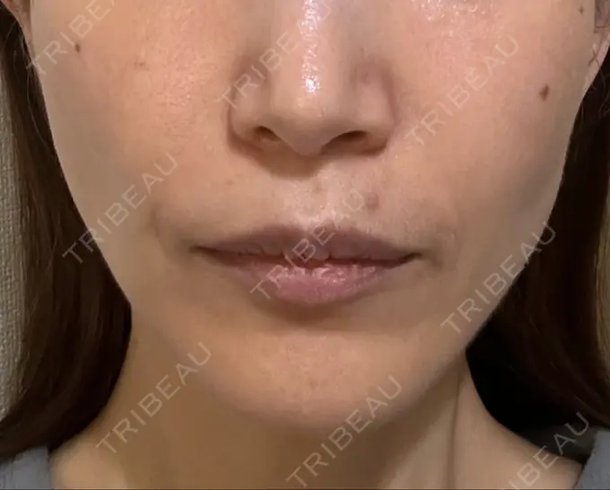 ルビーレーザー S-Laboクリニック 渋谷院 DAY 10 メイン用