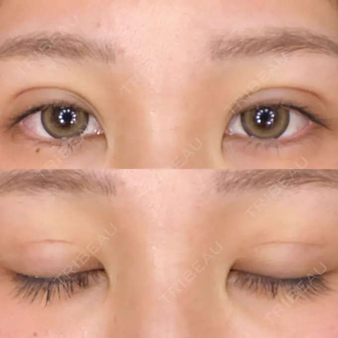 二重埋没 城本クリニック 大阪院 DAY 4 メイン用