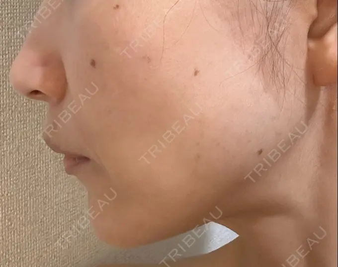 ルビーレーザー S-Laboクリニック 渋谷院 DAY 11 メイン用