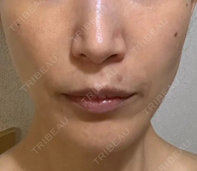 ルビーレーザー S-Laboクリニック 渋谷院 DAY 11 メイン用