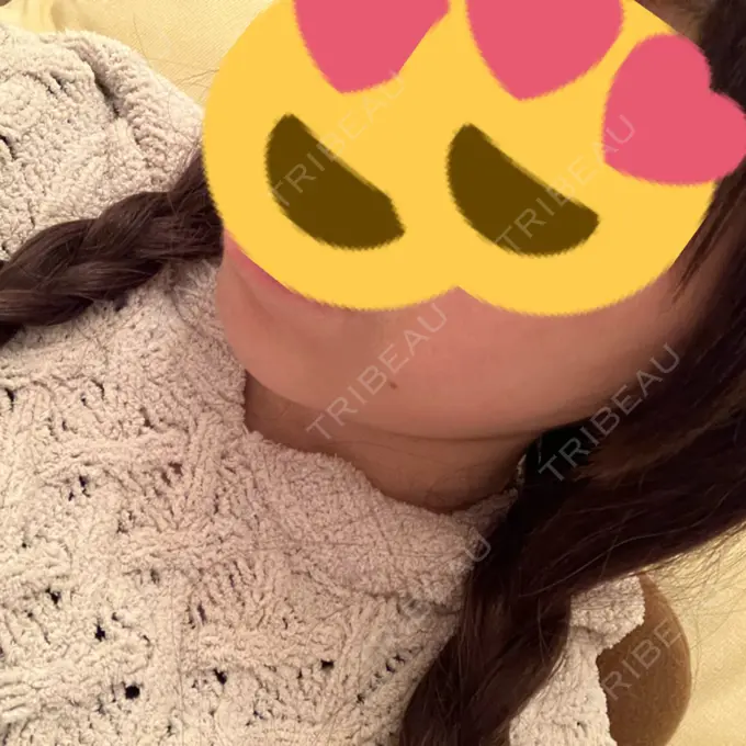 糸リフト / バッカルファット除去 / 脂肪吸引（顔） RIVER CLINIC（リバークリニック） DAY 2 メイン用