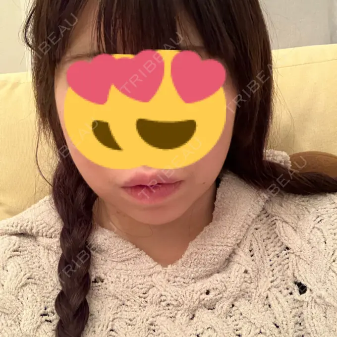 糸リフト / バッカルファット除去 / 脂肪吸引（顔） RIVER CLINIC（リバークリニック） DAY 2 メイン用