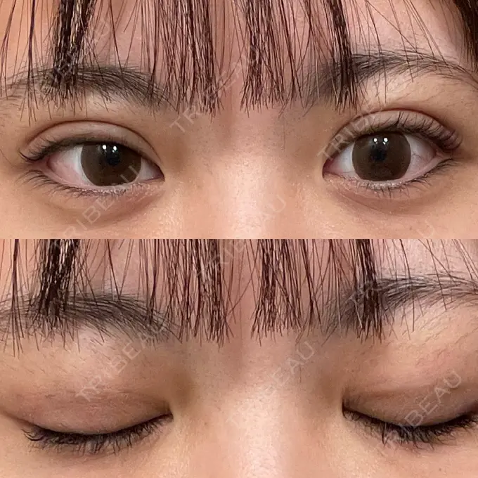 二重埋没 仙台TAクリニック DAY 8 メイン用