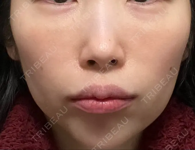 ハイフ（顔） 椿クリニック 心斎橋院 DAY 16 メイン用