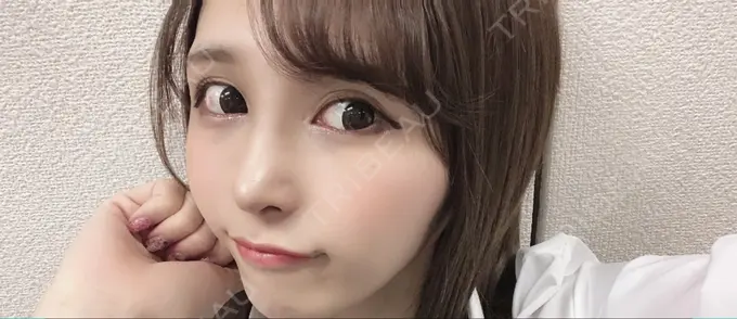 隆鼻術 / 鼻尖形成（切開） / 鼻中隔延長（切開） / 軟骨移植 / その他（鼻） FROM B整形外科 (旧バウム整形外科) AFTER メイン用