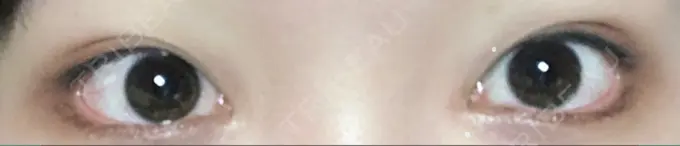 タレ目形成・グラマラスライン（切開） / 目尻靭帯移動 DIVINE（ディバイン）整形外科 DAY 29 メイン用