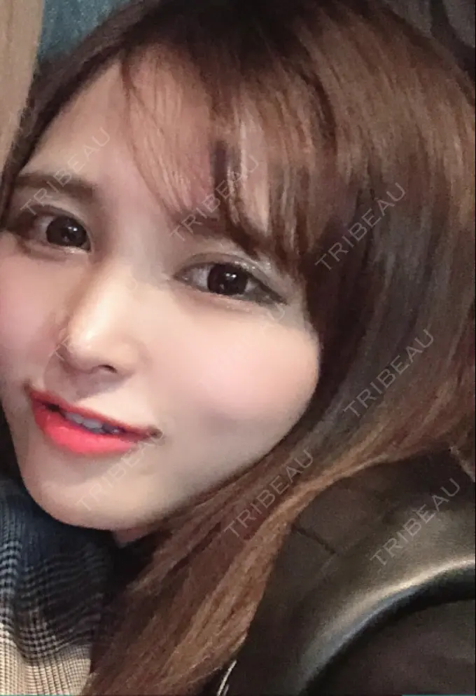 隆鼻術 / 鼻尖形成（切開） / 鼻中隔延長（切開） / 軟骨移植 / その他（鼻） FROM B整形外科 (旧バウム整形外科) DAY 27 メイン用