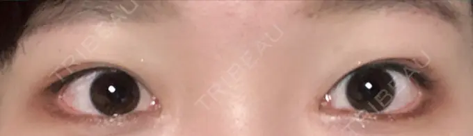 タレ目形成・グラマラスライン（切開） / 目尻靭帯移動 DIVINE（ディバイン）整形外科 AFTER メイン用