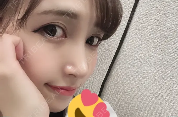 隆鼻術 / 鼻尖形成（切開） / 鼻中隔延長（切開） / 軟骨移植 / その他（鼻） FROM B整形外科 (旧バウム整形外科) DAY 27 メイン用