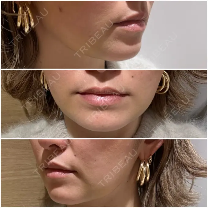 ジョールファット除去 / 脂肪吸引注射（顔） ziz CLINIC DAY 4 メイン用