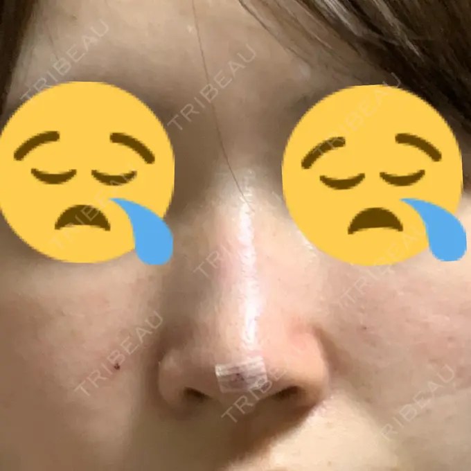 鼻中隔延長（非切開） TCB東京中央美容外科 八王子院 DAY 0 メイン用