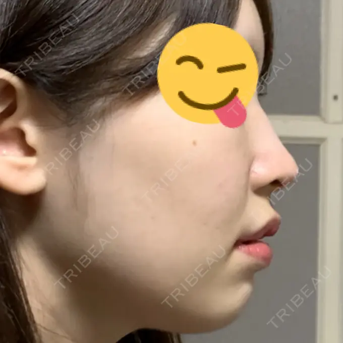 鼻中隔延長（非切開） TCB東京中央美容外科 八王子院 DAY 0 メイン用