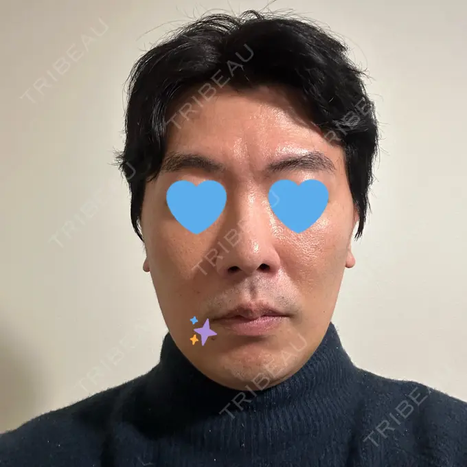 糸リフト / バッカルファット除去 / 脂肪吸引（顔） / メーラーファット除去 / ボトックス（エラ・小顔） RIVER CLINIC（リバークリニック） DAY 10 メイン用